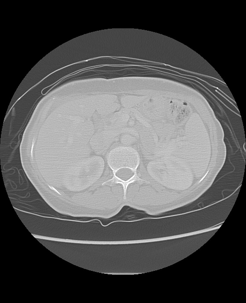 Chondrosarcoma (Radiopaedia 79427-92532 Axial lung window 60).jpg