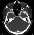 Chondrosarcoma - sphenoid wing (Radiopaedia 5421-7174 Axial bone window 1).jpg