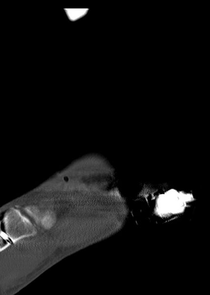 File:Chopart fracture (Radiopaedia 35347-36861 Sagittal bone window 24).jpg