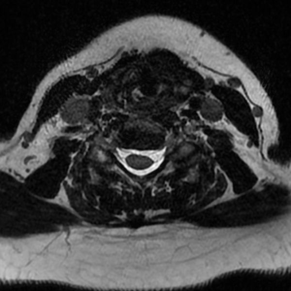 File:Chordoma - cervical spine (Radiopaedia 70084-80111 Axial T2 58).png