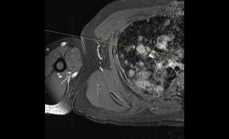 File:Choriocarcinoma in the shoulder (Radiopaedia 28603-28861 Axial T1 C+ fat sat 27).jpg