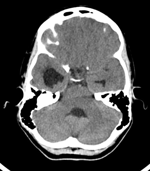 File:Choroid plexus carcinoma (Radiopaedia 91013-108552 Axial non-contrast 19).jpg