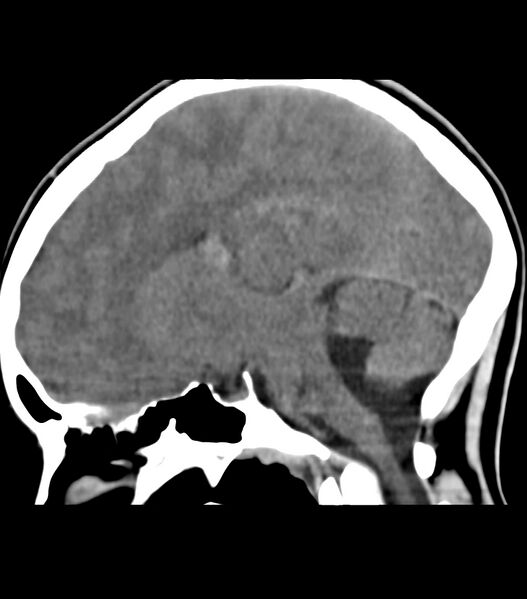 File:Choroid plexus carcinoma (Radiopaedia 91013-108552 B 38).jpg