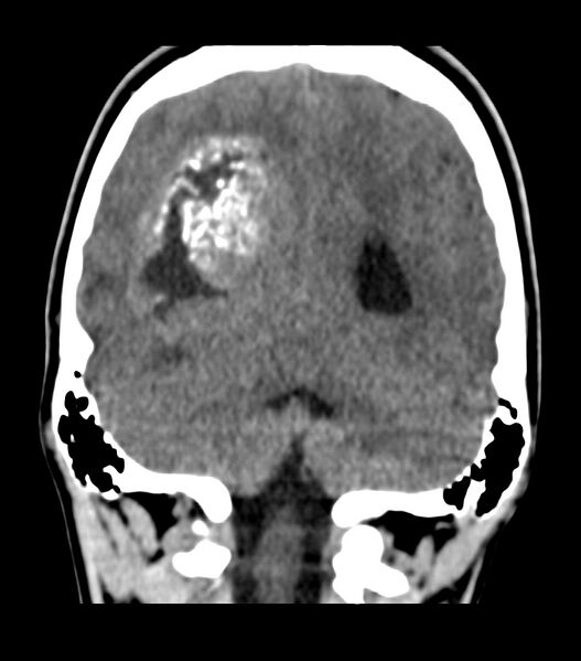 File:Choroid plexus carcinoma (Radiopaedia 91013-108552 Coronal non-contrast 63).jpg