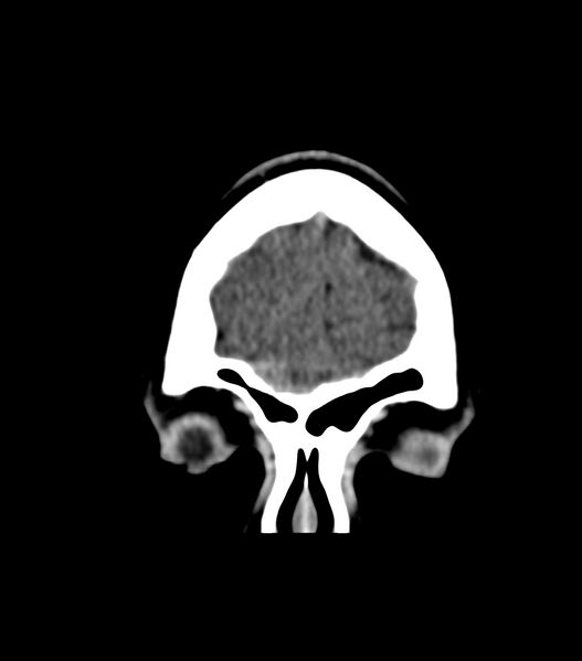 File:Choroid plexus carcinoma (Radiopaedia 91013-108552 Coronal non-contrast 8).jpg