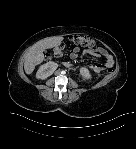 File:Chromophobe renal cell carcinoma (Radiopaedia 84239-99519 B 67).jpg
