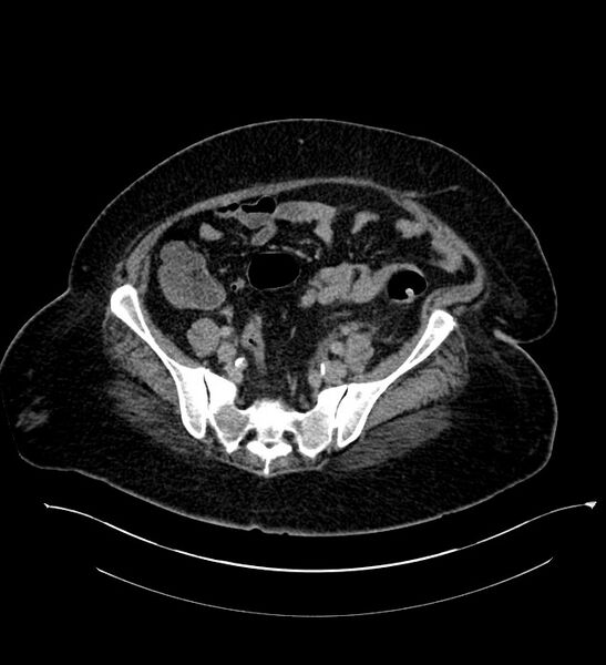 File:Chromophobe renal cell carcinoma (Radiopaedia 84239-99519 E 119).jpg