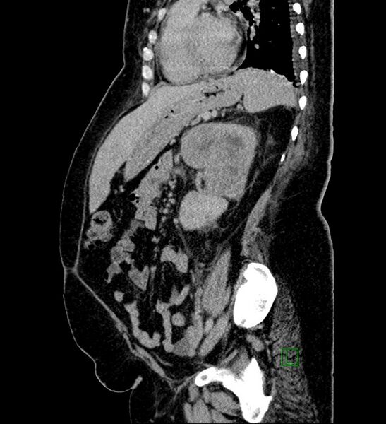 File:Chromophobe renal cell carcinoma (Radiopaedia 84239-99519 G 44).jpg
