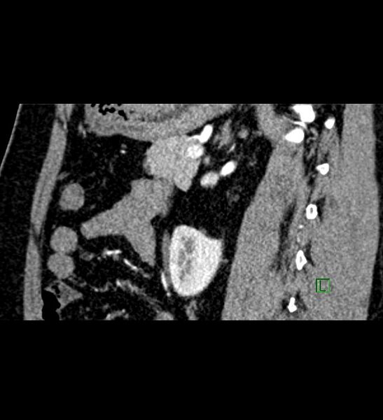 File:Chromophobe renal cell carcinoma (Radiopaedia 84286-99573 F 65).jpg