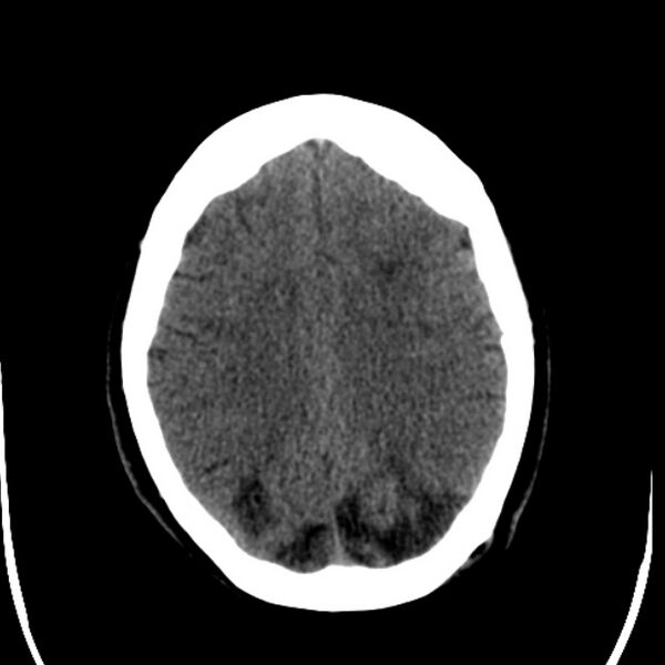 File:Chronic bilateral occipital lobe infarcts (Radiopaedia 31276-31996 Axial non-contrast 30).jpg