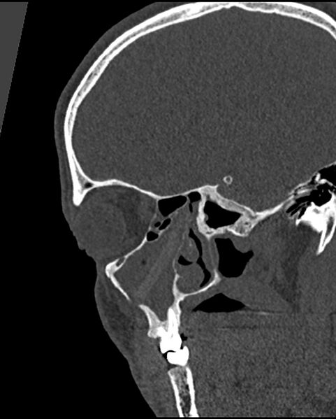 File:Chronic maxillary sinusitis caused by a foreign body (Radiopaedia 58521-65676 Sagittal bone window 20).jpg