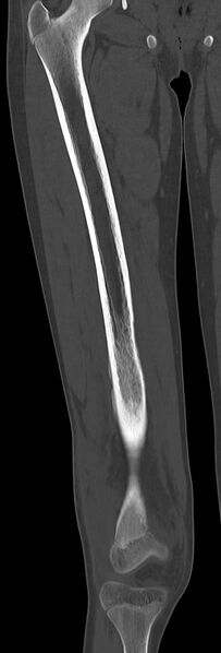 File:Chronic ostemyelitis of the femur with long sinus tract (Radiopaedia 74947-85982 Coronal bone window 38).jpg