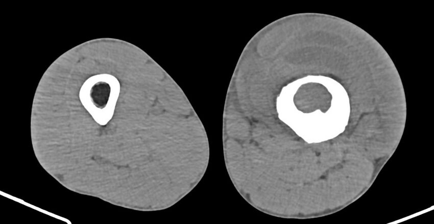 Chronic osteomyelitis (with sequestrum) (Radiopaedia 74813-85822 D 114).jpg