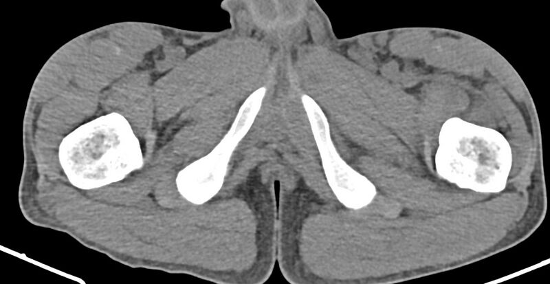 File:Chronic osteomyelitis (with sequestrum) (Radiopaedia 74813-85822 D 54).jpg