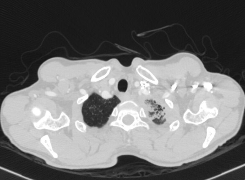 File:Chronic pulmonary embolism with bubbly consolidation (Radiopaedia 91248-108850 Axial lung window 5).jpg