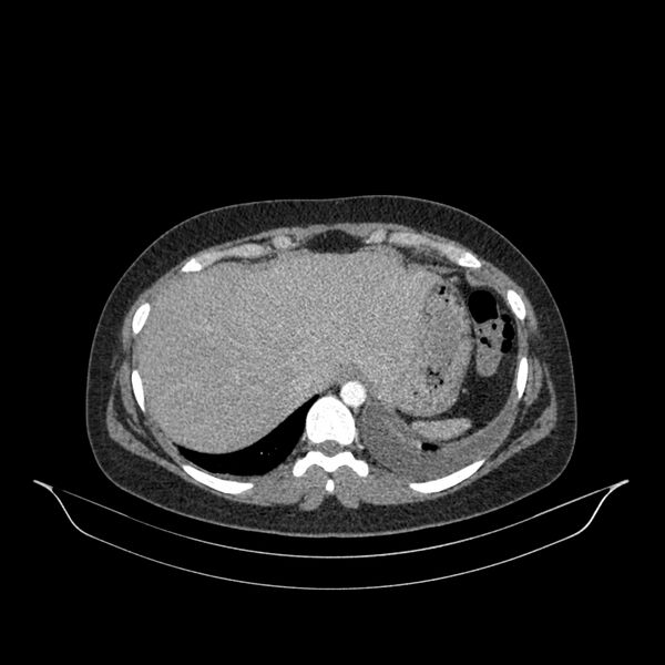 File:Chronic thromboembolic pulmonary hypertension (CTEPH) (Radiopaedia 74597-85532 Axial C+ CTPA 25).jpg