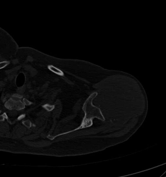 File:Clear cell chondrosarcoma - humerus (Radiopaedia 63104-71612 Axial bone window 27).jpg