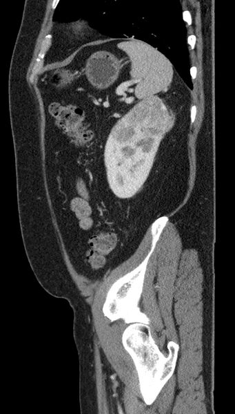 File:Clear cell renal cell carcinoma (Radiopaedia 61449-69393 G 14).jpg