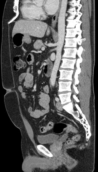 File:Clear cell renal cell carcinoma (Radiopaedia 61449-69393 G 52).jpg