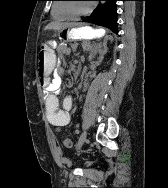 File:Closed-loop small bowel obstruction-internal hernia (Radiopaedia 78439-91096 C 64).jpg