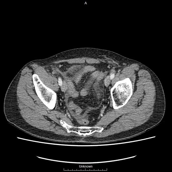File:Closed loop bowel obstruction and ischemia (Radiopaedia 86959-103180 A 76).jpg
