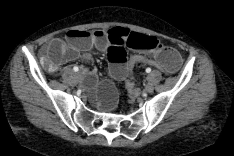 File:Closed loop small bowel obstruction (Radiopaedia 71211-81508 A 120).jpg
