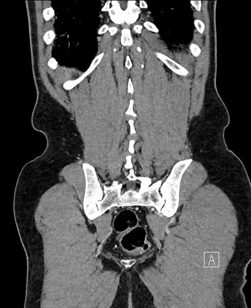 File:Closed loop small bowel obstruction - internal hernia (Radiopaedia 57806-64778 A 103).jpg