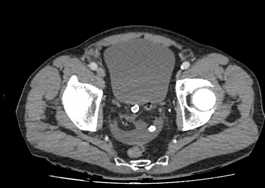 Closed loop small bowel obstruction with ischemia (Radiopaedia 84180-99456 A 108).jpg