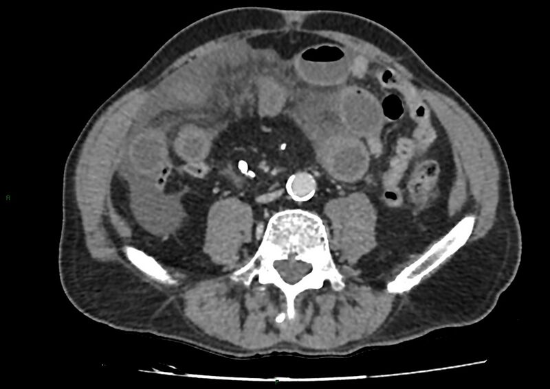 File:Closed loop small bowel obstruction with ischemia (Radiopaedia 84180-99456 A 70).jpg