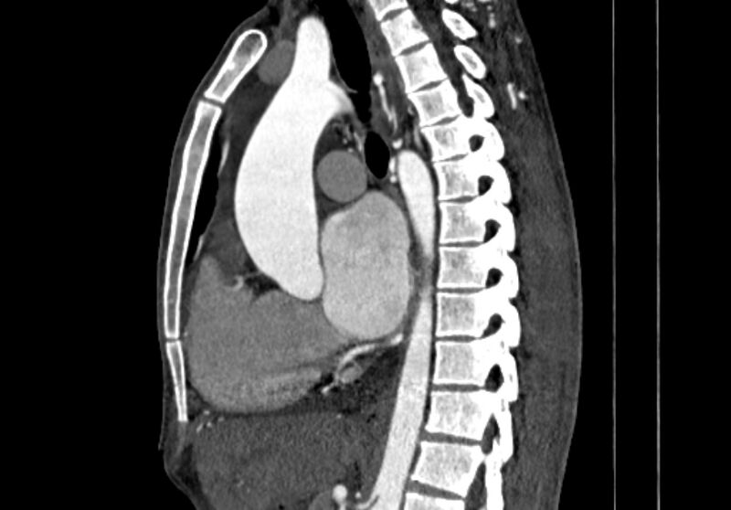 File:Coarctation of aorta with aortic valve stenosis (Radiopaedia 70463-80574 B 61).jpg