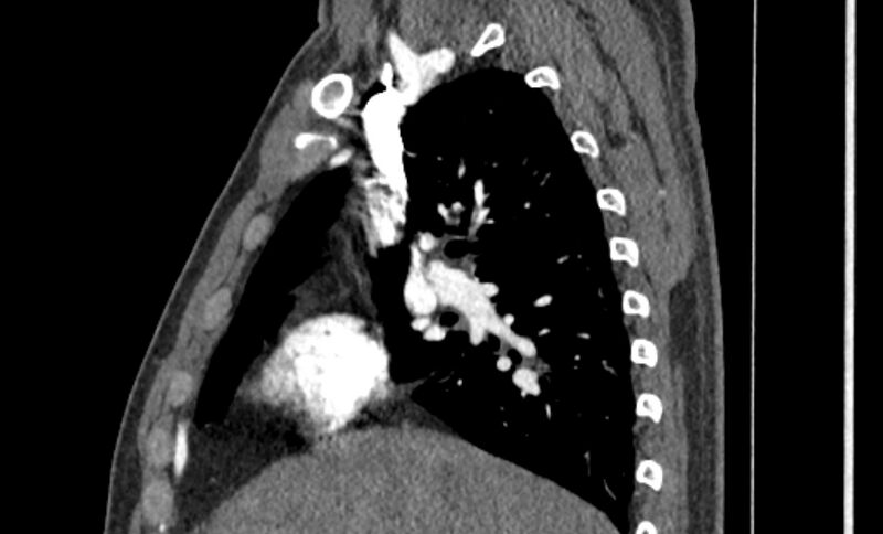 File:Coarctation of the aorta (Radiopaedia 53363-59343 B 15).jpg