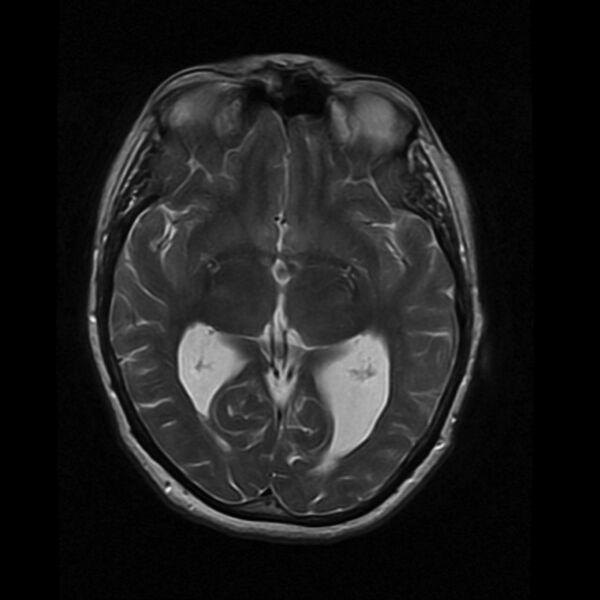 File:Colloid cyst with hydrocephalus (Radiopaedia 9373-10065 Axial T2 9).jpg