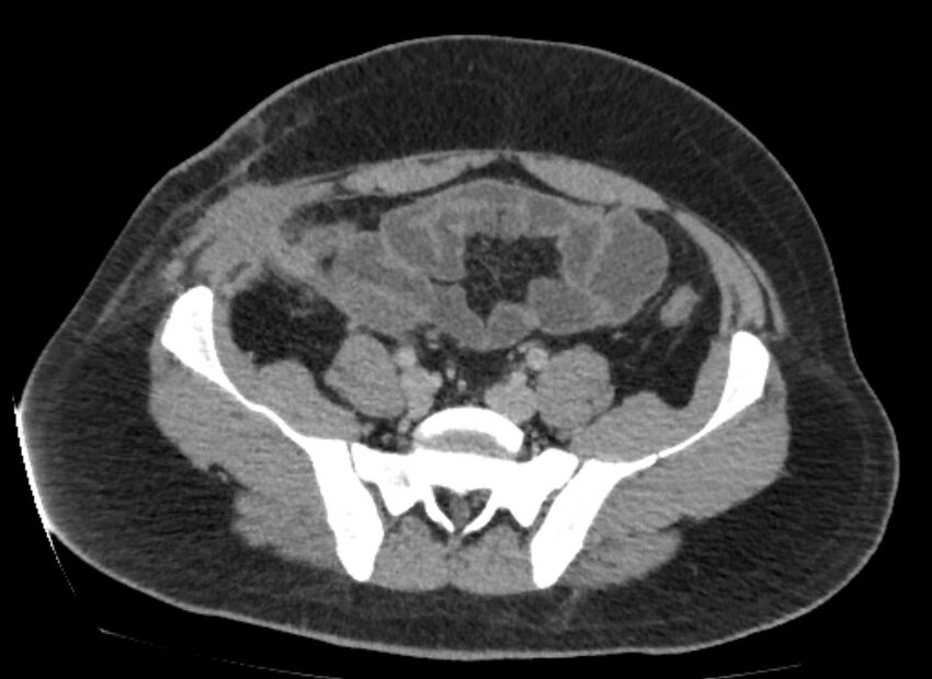 Colocutaneous fistula (Radiopaedia 56401-63062 A 68).jpg