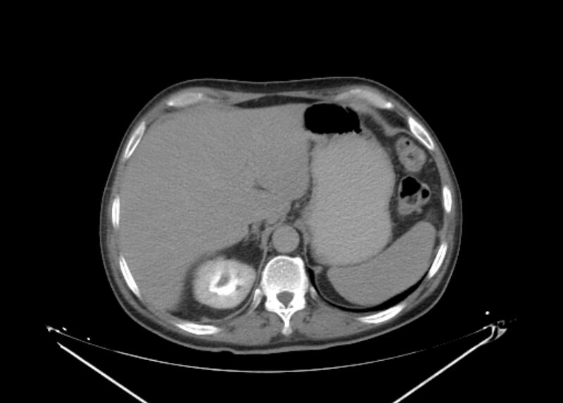 File:Colon cancer mimicking renal cell carcinoma (Radiopaedia 28986-29335 Axial C+ delayed 14).jpg