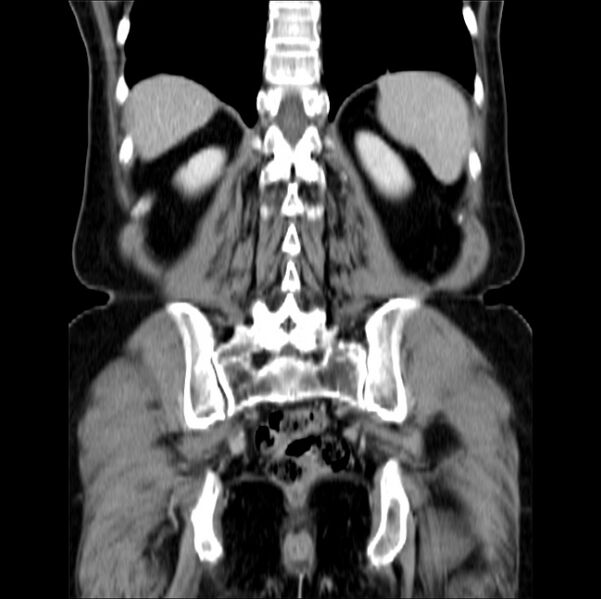File:Colon carcinoma with hepatic metastases (Radiopaedia 29477-29961 B 34).jpg