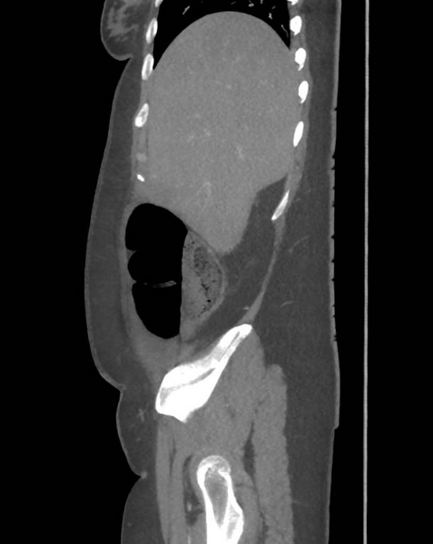 File:Colonic pseudo-obstruction (Radiopaedia 79752-92980 C 18).png