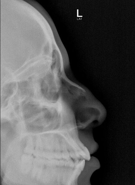 File:Nasal bone fracture (Radiopaedia 68085).jpg