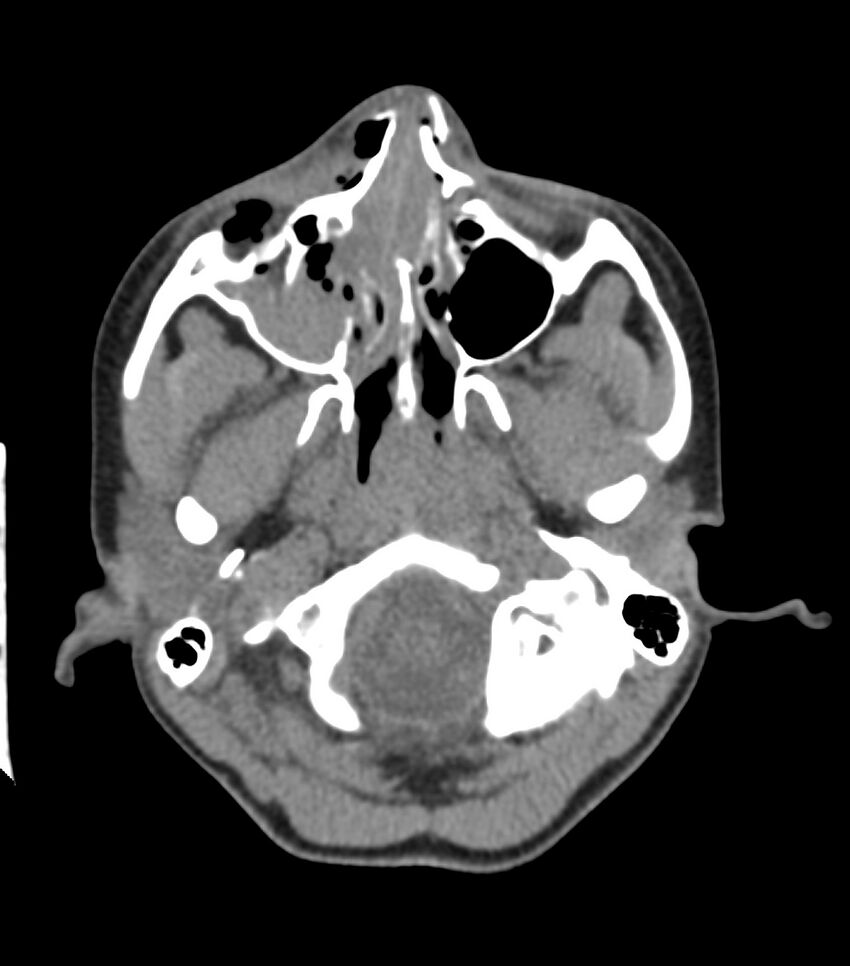 Nasoorbitoethmoid fracture (Radiopaedia 90044-107205 Axial non-contrast 134).jpg