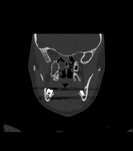 File:Nasoorbitoethmoid fracture (Radiopaedia 90044-107205 Coronal bone window 62).jpg