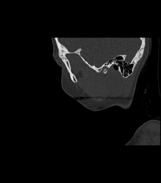 File:Nasoorbitoethmoid fracture (Radiopaedia 90044-107205 Sagittal bone window 121).jpg