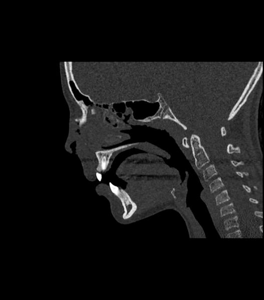 File:Nasoorbitoethmoid fracture (Radiopaedia 90044-107205 Sagittal bone window 70).jpg