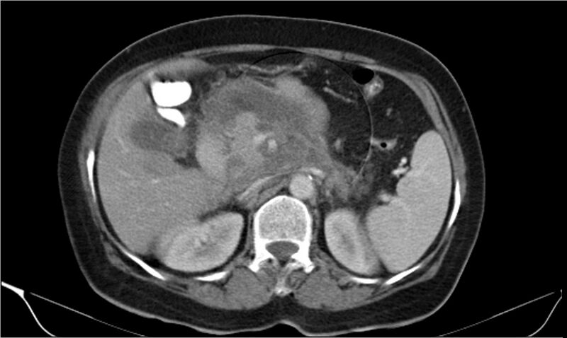 File:Necrotizing pancreatitis (Radiopaedia 20595-20495 A 13).jpg