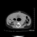 Neonatal neuroblastoma (Radiopaedia 56651-63438 Axial non-contrast 54).jpg