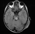 Neurofibromatosis type 1 (Radiopaedia 6954-8063 Axial FLAIR 4).jpg