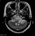 Neurofibromatosis type 2 - cranial and spinal involvement (Radiopaedia 5351-7111 Axial T2 4).jpg