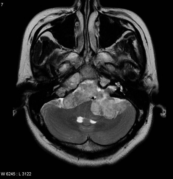 File:Neurofibromatosis type 2 - cranial and spinal involvement (Radiopaedia 5351-7111 Axial T2 4).jpg