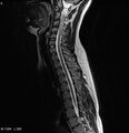 Neurofibromatosis type 2 - cranial and spinal involvement (Radiopaedia 5351-7112 Sagittal T2 5).jpg