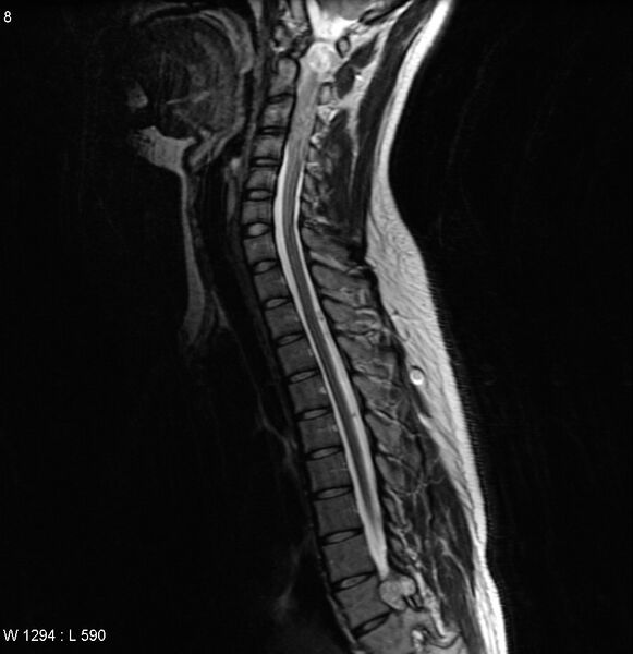 File:Neurofibromatosis type 2 - cranial and spinal involvement (Radiopaedia 5351-7112 Sagittal T2 5).jpg