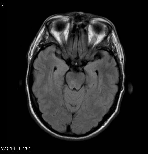 File:Neurosarcoidosis (Radiopaedia 10930-17204 Axial FLAIR 7).jpg