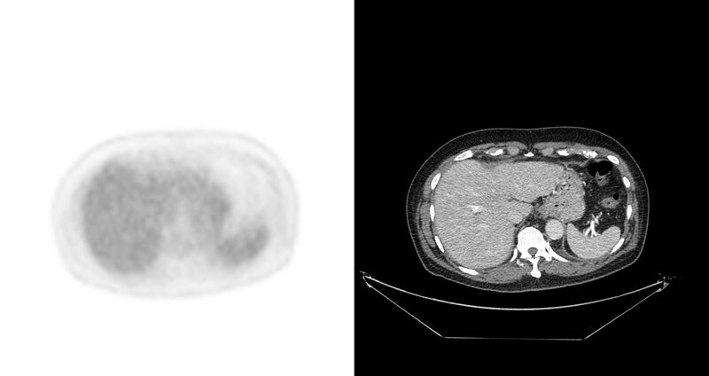 File:Non-Hodgkin lymphoma involving seminal vesicles with development of interstitial pneumonitis during Rituximab therapy (Radiopaedia 32703-33675 axial PET CT 38).jpg
